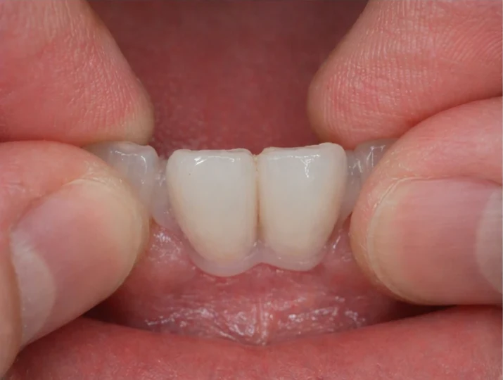 Denticor – înlocuire rapidă a celor doi incisivi frontali inferiori: spațiu liber, punte DentiFlex pregătită cu doi dinți, inserare ca un tot unitar și rezultat