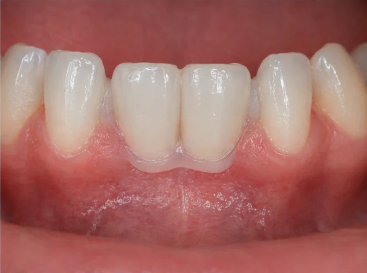 Denticor – înlocuire rapidă a celor doi incisivi frontali inferiori: spațiu liber, punte DentiFlex pregătită cu doi dinți, inserare ca un tot unitar și rezultat