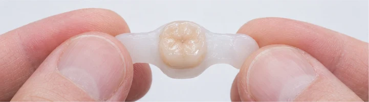 Ghid vizual – molar superior lipsă cu dinții adiacenți