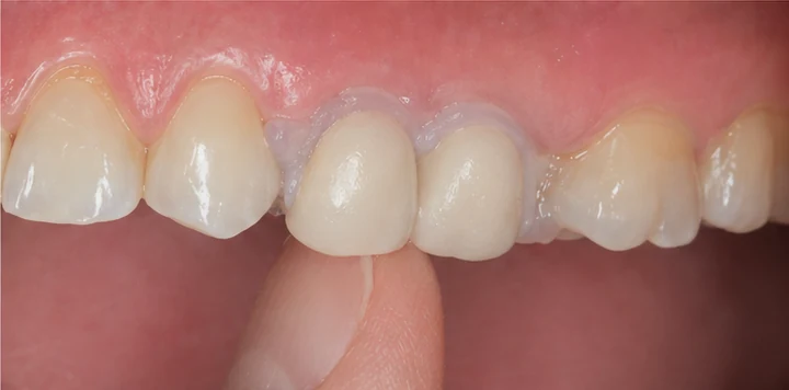Ghid vizual – molar superior lipsă cu dinții adiacenți