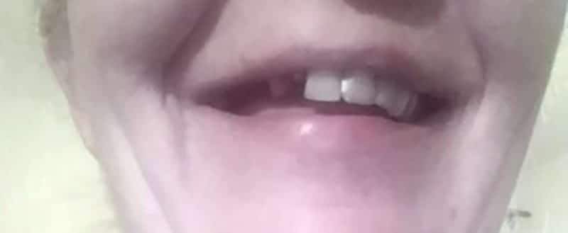 Clienta – dinte frontal rupt, înainte de aplicarea Denticor