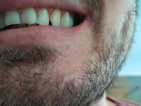 Dinte lateral completat cu o proteză Denticor, vedere laterală