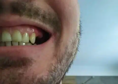 Dinte lateral lipsă înainte de utilizarea Denticor, vedere laterală