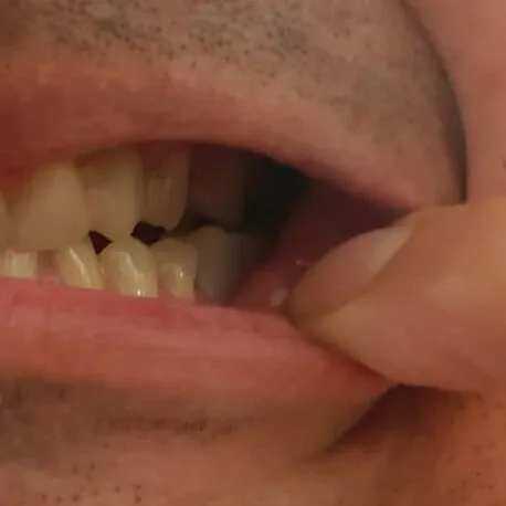 Client – dinte inferior completat cu Denticor