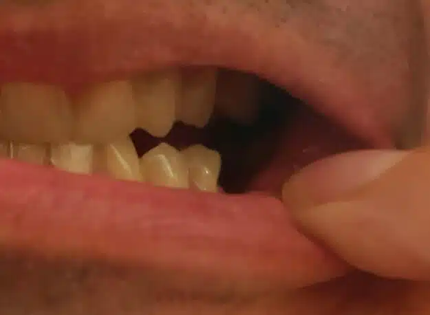 Client – dinte inferior lipsă