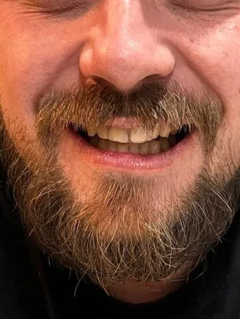 Zâmbet complet după completarea dintelui frontal cu o proteză Denticor