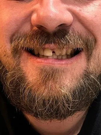 Spațiul de după dintele frontal în zâmbet înainte de utilizarea Denticor