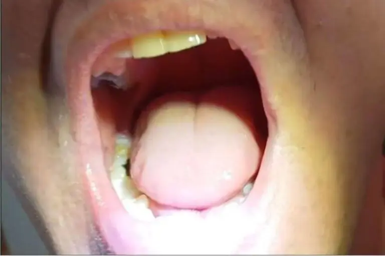 Cliență – dinte lateral refăcut cu Denticor
