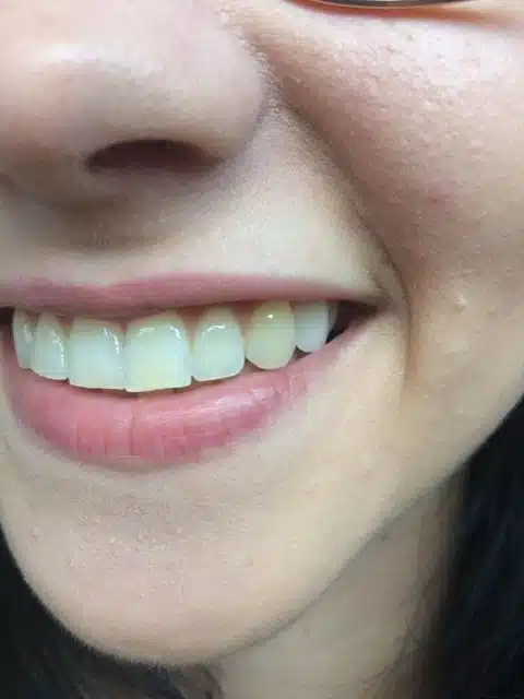Zâmbetul după montarea unui dinte nou personalizat Denticor