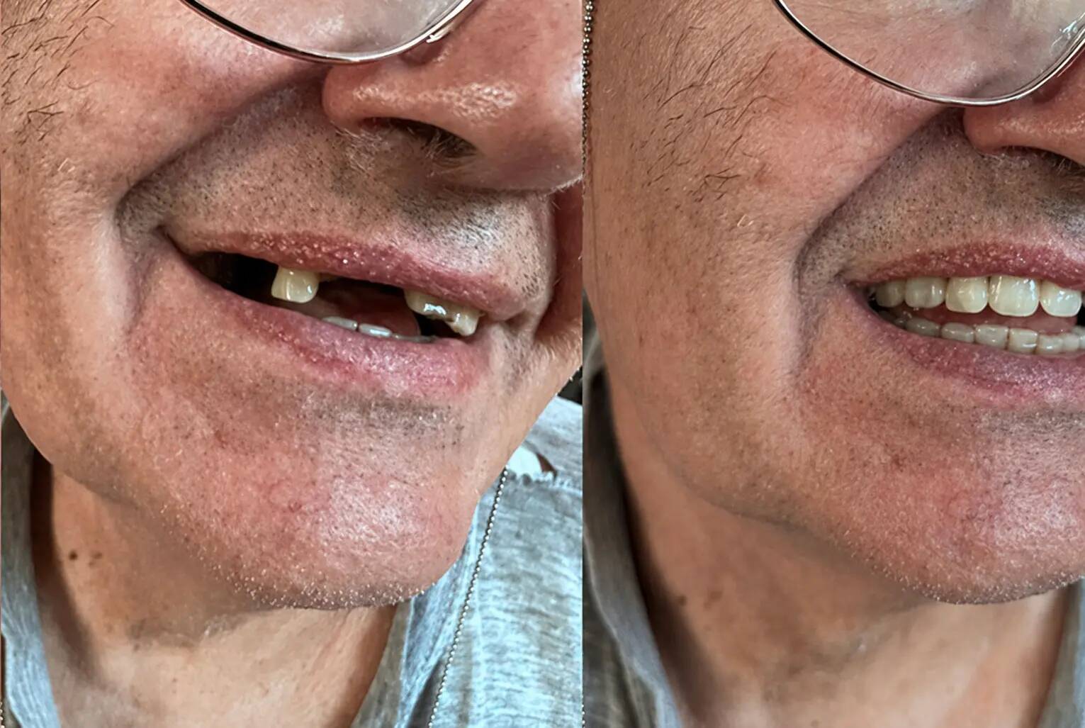 Client – mai mulți dinți lipsă înainte și după Denticor